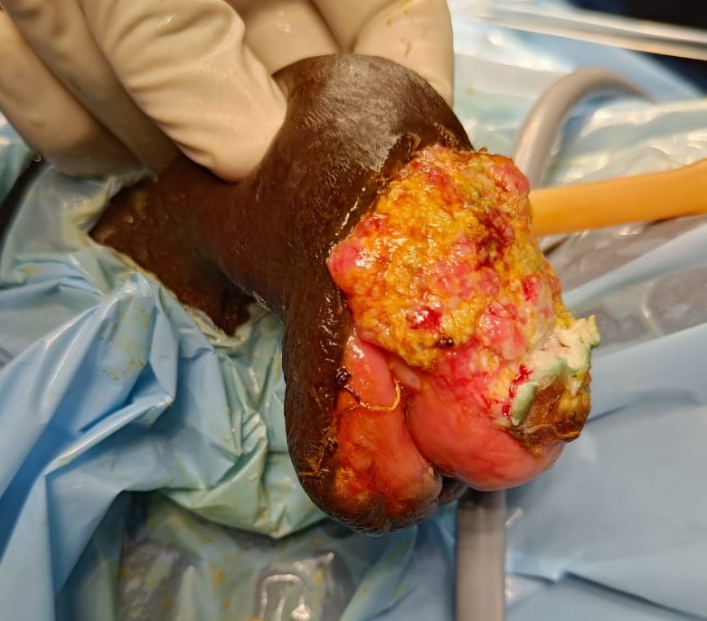 cancer-penis operated by Dr. Varun V. Agarwal, Best Uro-Oncologist and Robotic Surgeon in Vashi, Navi Mumbai.